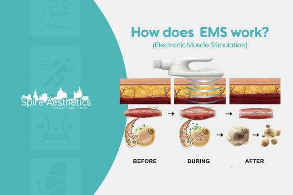 EMS treatment for post pregnancy weight loss treatment Lancashire