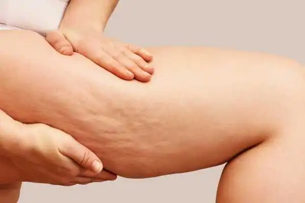 Image of woman showing leg with cellulite Lancashire
