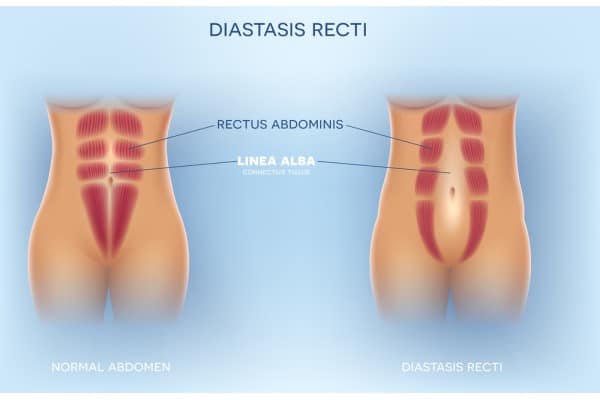 What Non-Surgical Options Are Available for Diastasis Recti Lancashire?