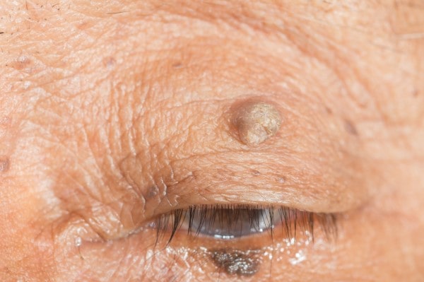 Skin imperfections Lancashire - Cryopen is fast and effective book in today!
