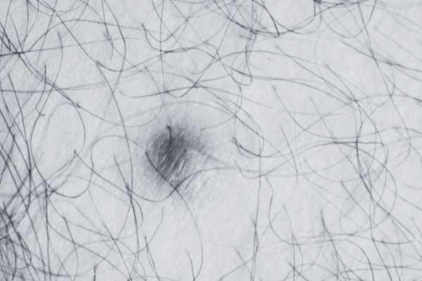 Dermatofibroma removal Lancashire made simple! Book in today!
