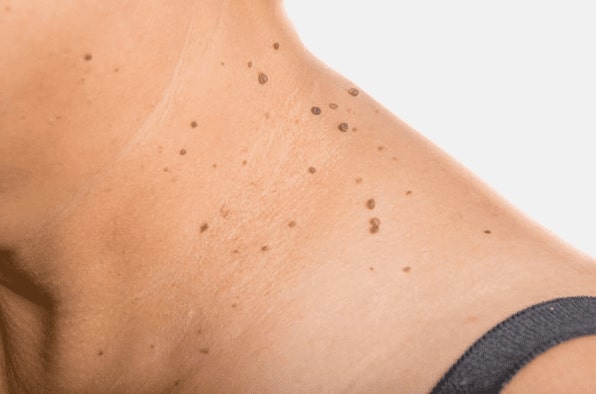 Are you looking for easy skin tag removal Lancashire - then contact Spire today!