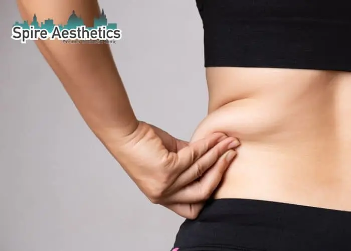 Image of woman pinching fat on their hips Lancashire. Fat Freezing treatment 