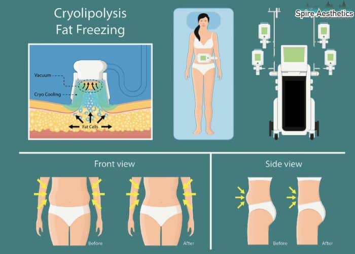 Image of diet and fat freezing combined for best results for Spire Aesthetics Lancashire