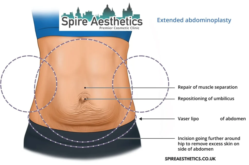 Understanding Loose Skin After Gastric Band Lancashire Surgery and HIFU Treatment