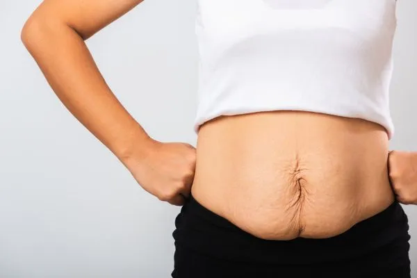 Image of a woman's stomach after weight loss with sagging skin following a gastric band Lancashire