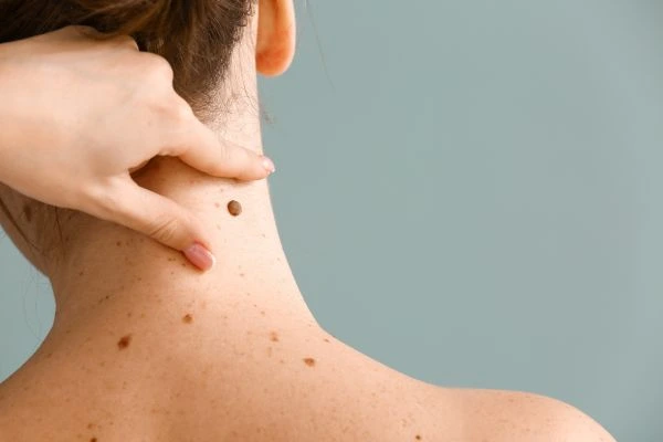 Prices and promotions for blemish removal Lancashire contact our team today!