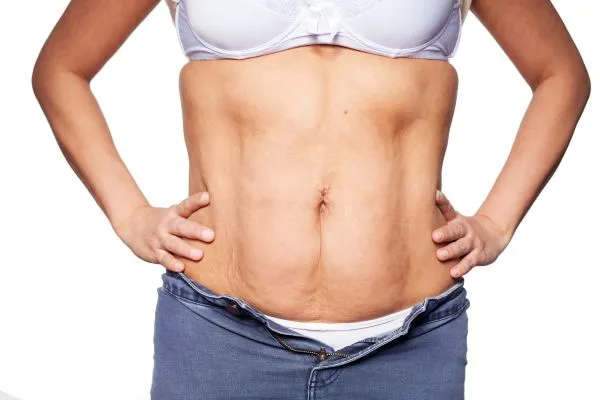 sagging skin on woman's stomach after weight loss injections Lancashire