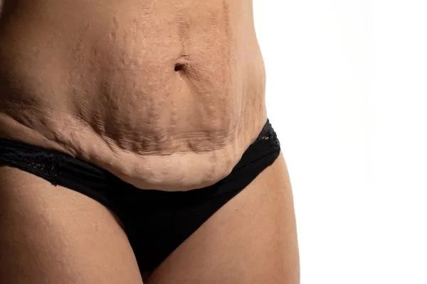 Image of womans stomach after weight loss injections Lancashire showing saggy skin
