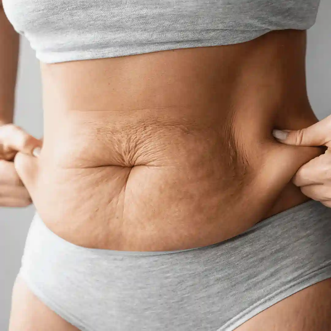Is It Normal to Have Loose Skin After Pregnancy Lancashire?