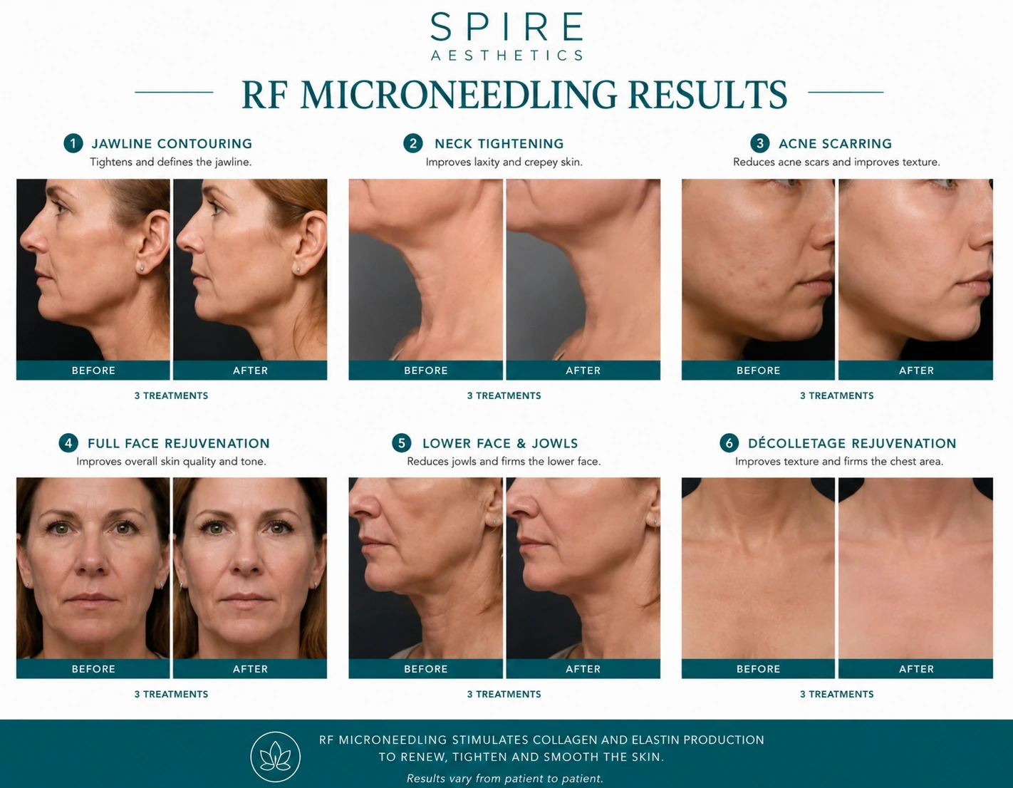 RF Microneedling Skin tightening Lancashire results