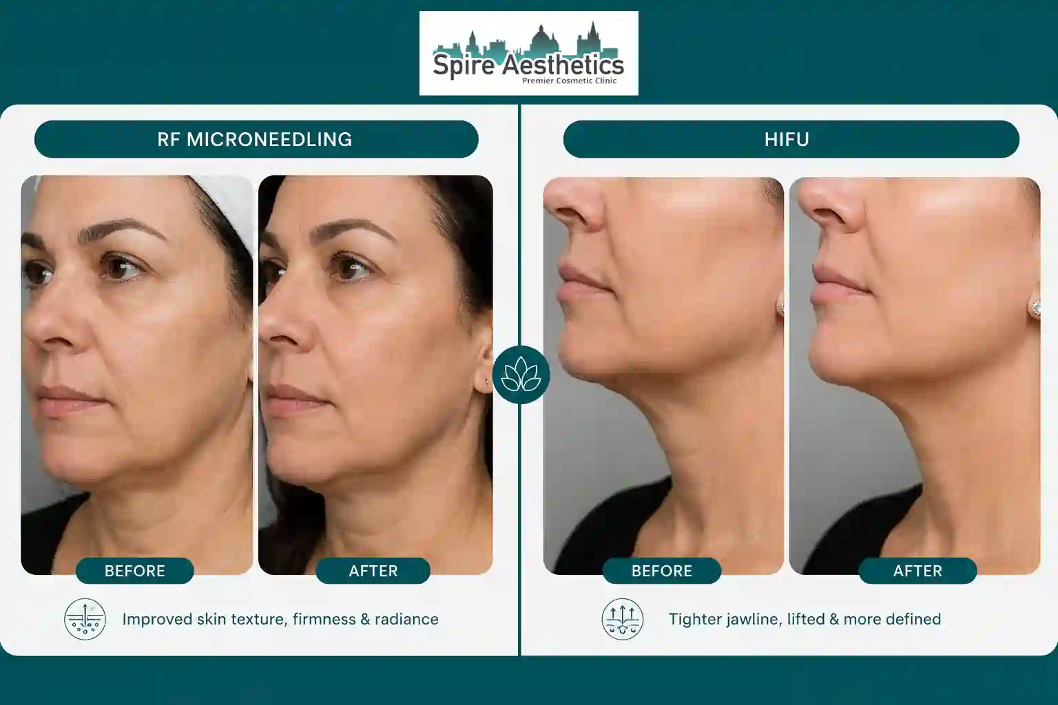 Can RF Microneedling and HIFU Be Combined Lancashire?